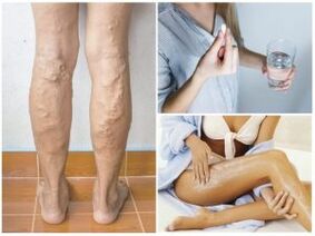 Κιρσοί φλέβες στα πόδια και τις μεθόδους θεραπείας