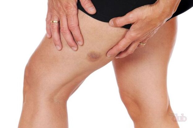 αν σκάσει μια φλέβα